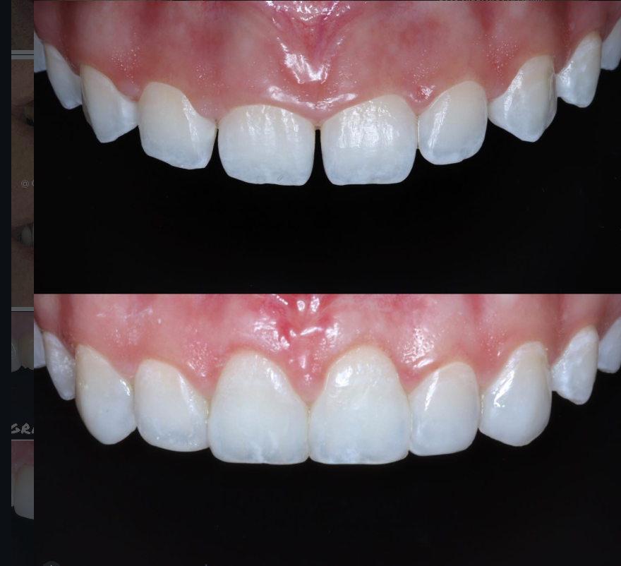 Caso Clínico 10 - Lentes de Contato Dental