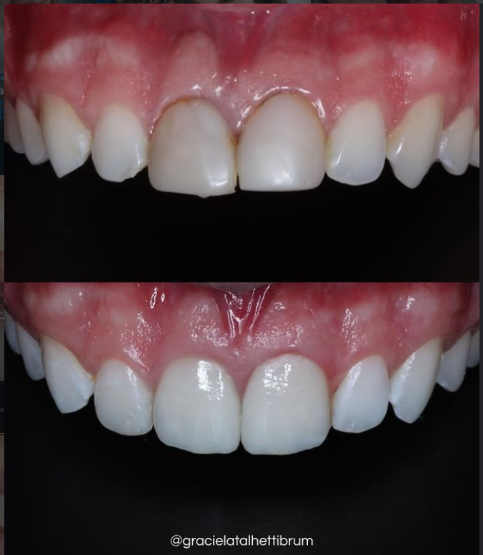 Caso Clínico 6 - Lentes de Contato Dental
