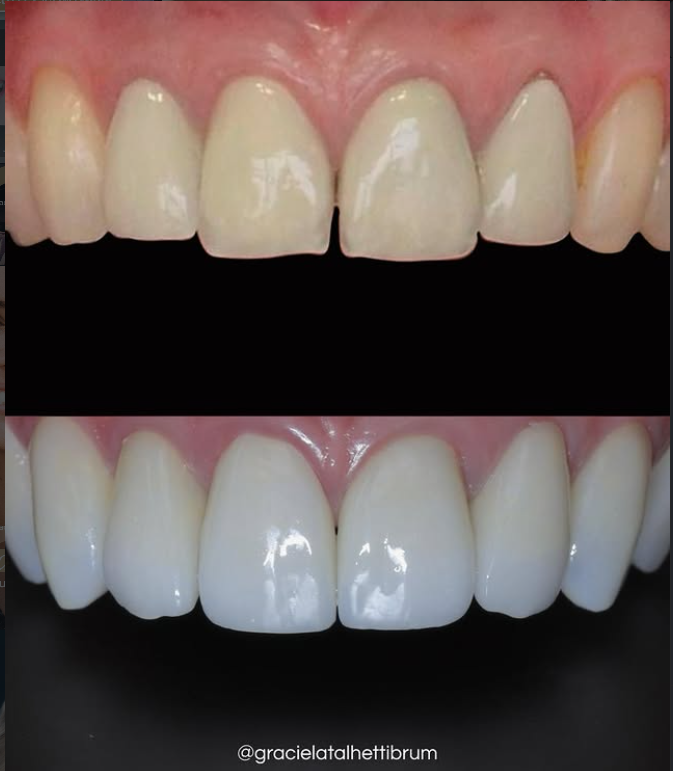 Caso Clínico 7 - Lentes de Contato Dental