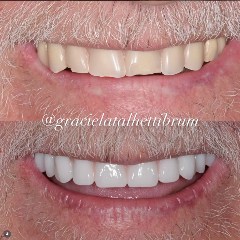Caso Clínico 9 - Reabilitação Oral Estética